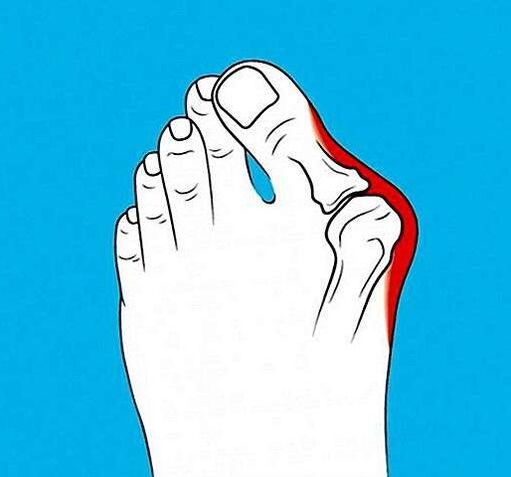 artrose da articulación no dedo do pé