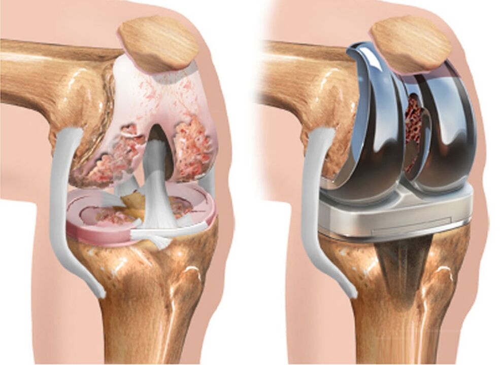 antes e despois da artrose da articulación do xeonllo para a artrose