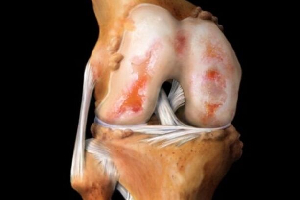 danos na cartilaxe na artrose do xeonllo