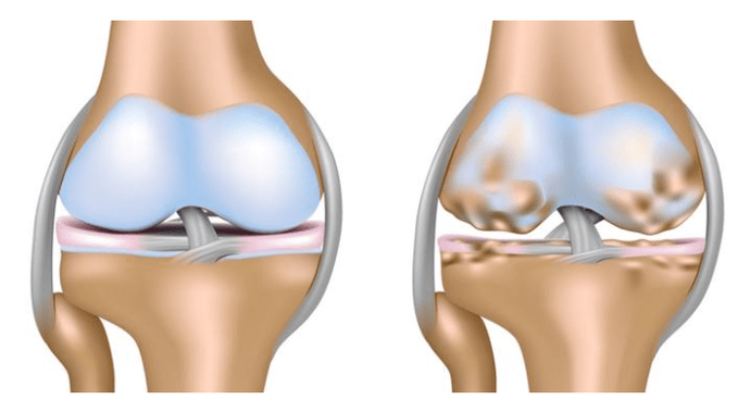 cartilaxe saudable e danos na articulación do xeonllo con artrose