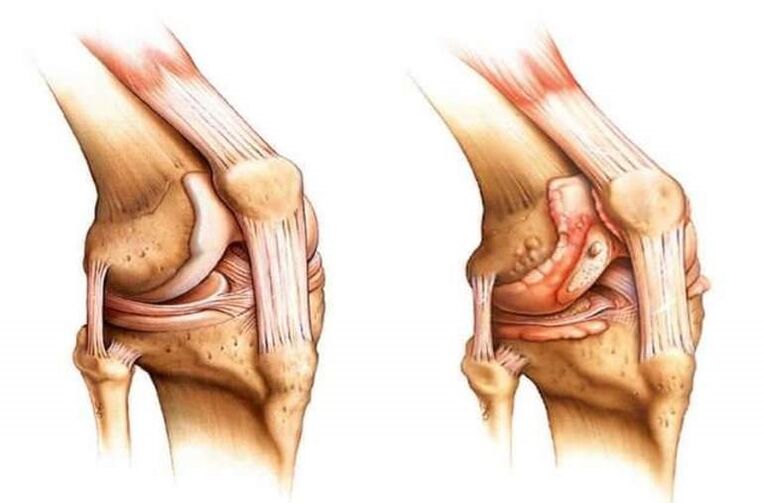 xeonllo saudable e artrose da articulación do xeonllo