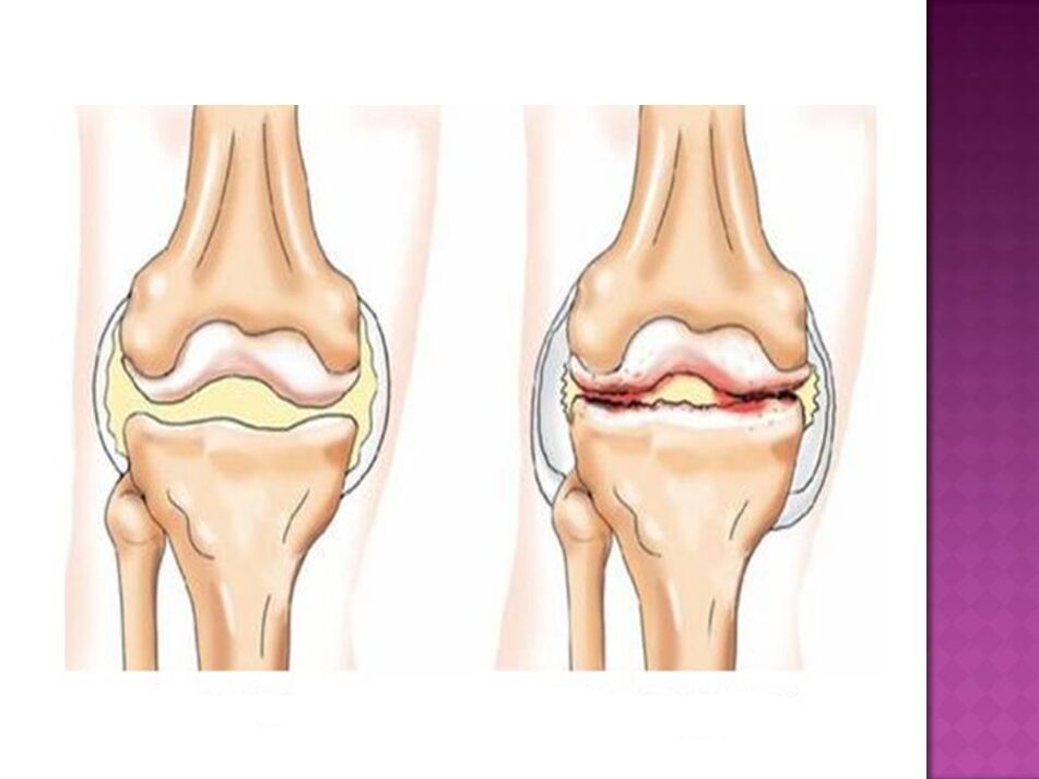 A articulación é normal (esquerda) e está afectada pola artrose (dereita)