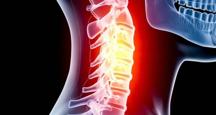 Inflamación da rexión cervical