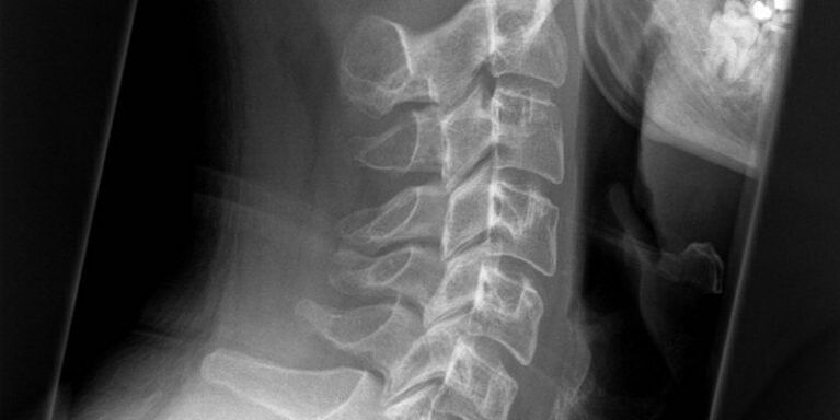 Unha imaxe da rexión cervical