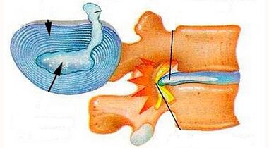 Características do desenvolvemento da osteocondrose cervical