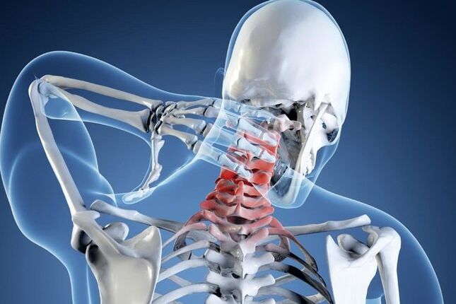 osteocondrose da columna cervical